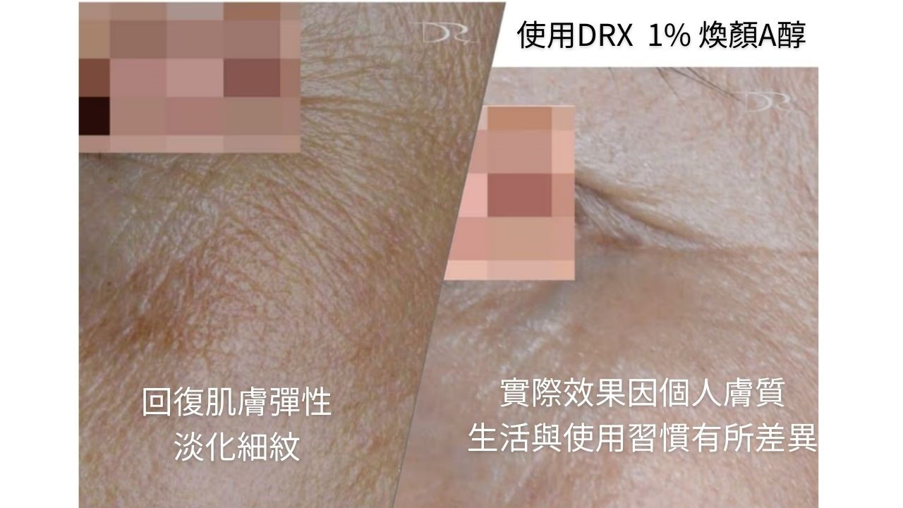 一直跟青春痘抗戰的病人們，都相當關心自己手上的第三代A酸藥膏是否跟第一代A酸在對抗光老化有一樣的效果，第三代A酸在實現年輕肌膚方面的研究相對於第一代A酸要少得多。這一篇文章會來為大家解惑！