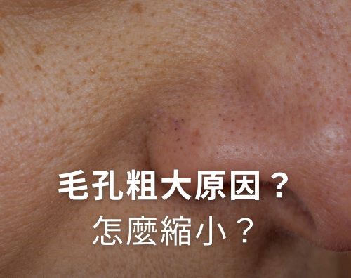 毛孔粗大原因？毛孔怎麼縮小？