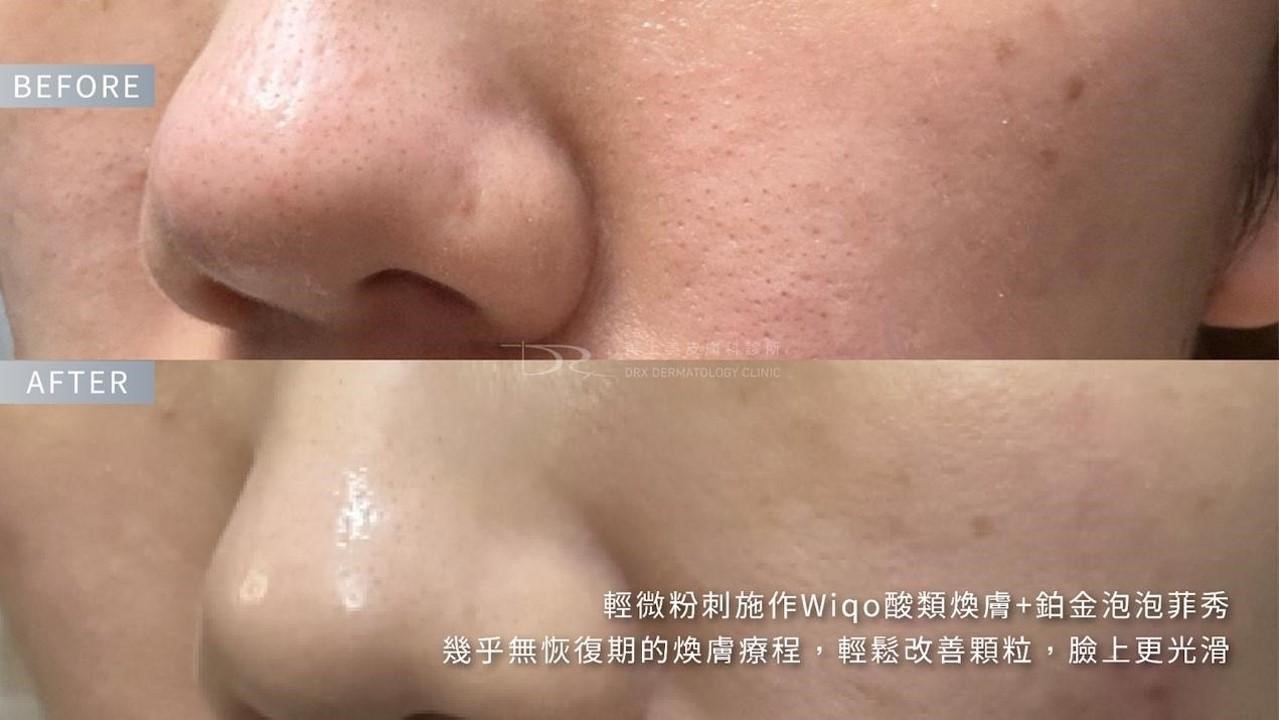 毛孔粗大原因？毛孔怎麼縮小？