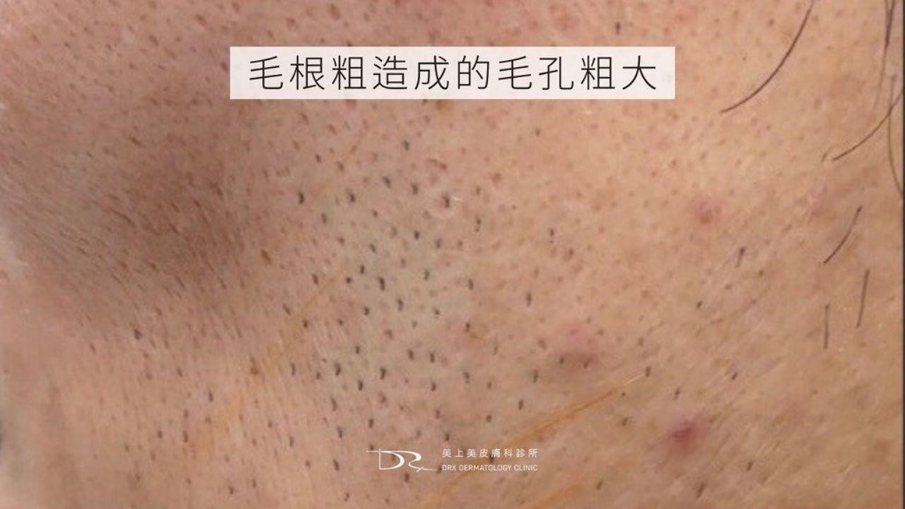 毛孔粗大原因？毛孔怎麼縮小？