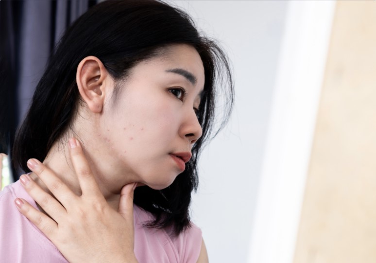 痘膚潤可以每天擦嗎？第三代Ａ酸哪裡買、功效與使用方法一次告訴你！