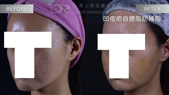 生長因子是什麼？EGF或外泌體保養品是什麼？有效嗎?