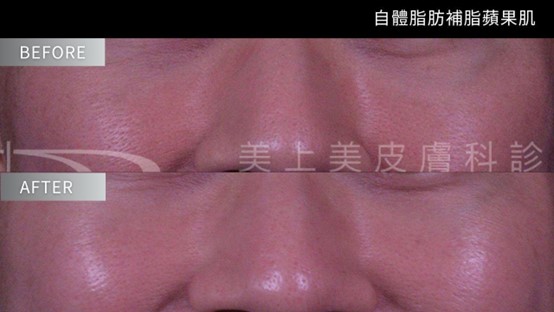 生長因子是什麼？EGF或外泌體保養品是什麼？有效嗎?