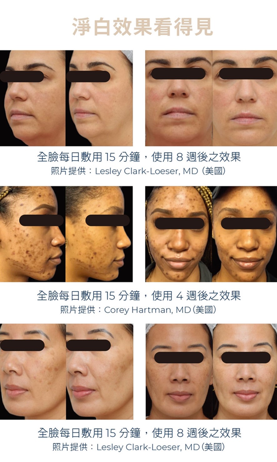 Cyspera希思珮樂淡斑乳霜有解！希思珮樂一代到三代差異比較一次看懂！