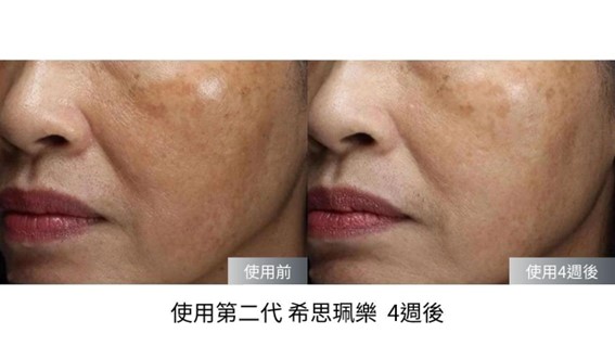 Cyspera希思珮樂淡斑乳霜有解！希思珮樂一代到三代差異比較一次看懂！