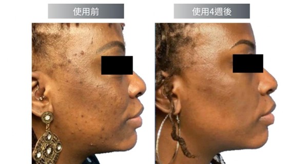 Cyspera希思珮樂淡斑乳霜有解！希思珮樂一代到三代差異比較一次看懂！