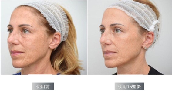 Cyspera希思珮樂淡斑乳霜有解！希思珮樂一代到三代差異比較一次看懂！