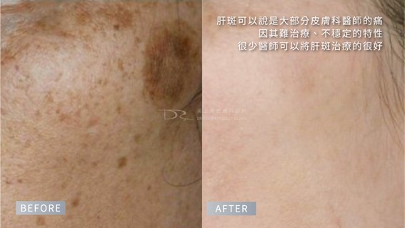 Cyspera希思珮樂淡斑乳霜有解！希思珮樂一代到三代差異比較一次看懂！