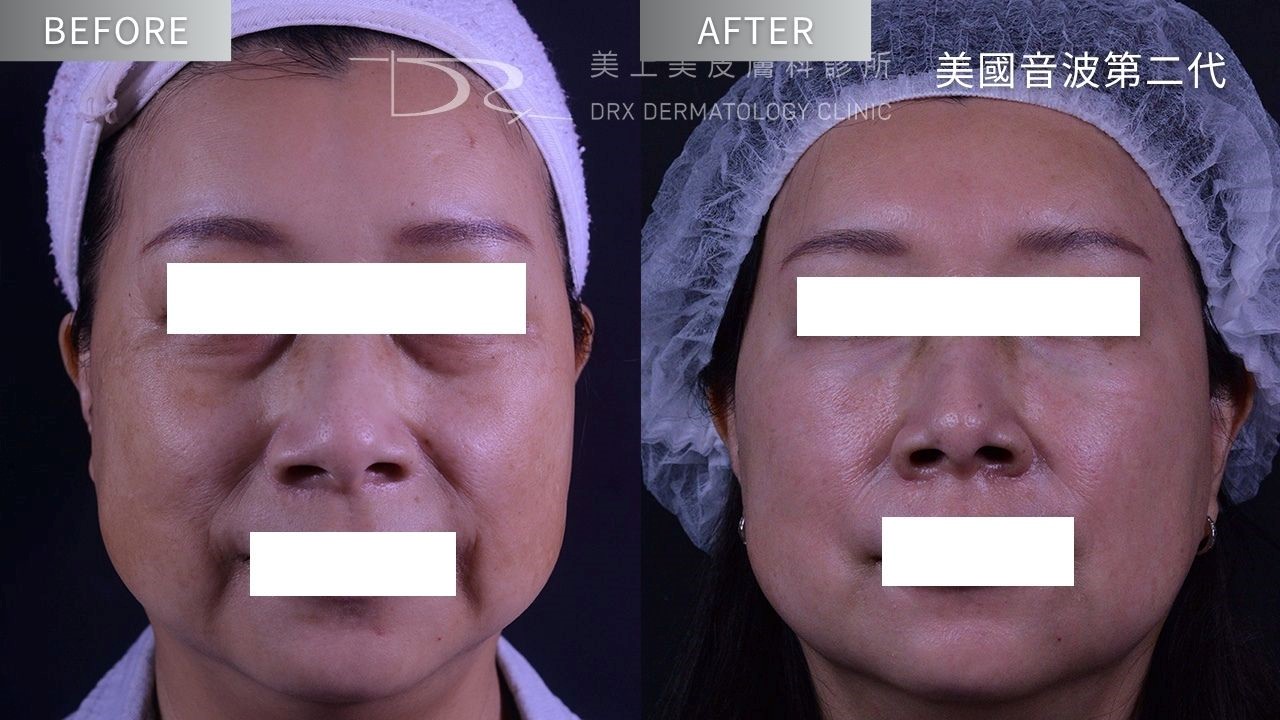 微電流美容儀有效嗎？科學依據、效果與常見疑問全解密？