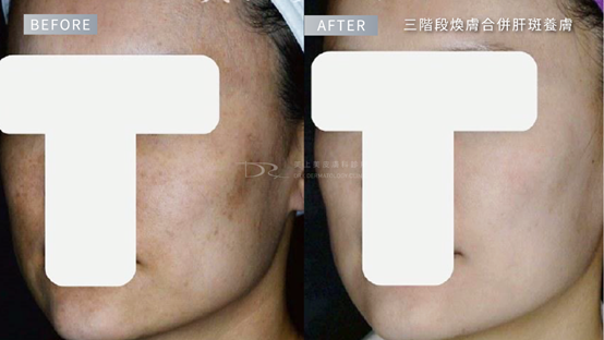 淡斑推薦成分？熊果素要跟哪些成分一起用效果最好？