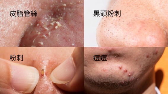 妙鼻貼、黑頭鏟真的有用嗎？粉刺清除真相公開！