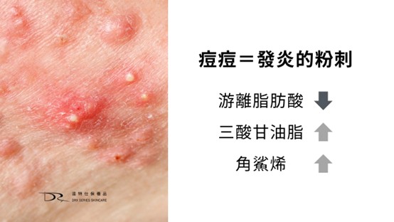 粉刺跟痘痘的差別？粉刺痘痘怎麼消？