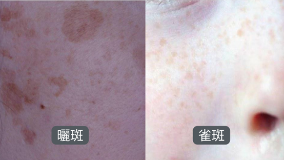 斑越打越多？臉上的斑如何去除？