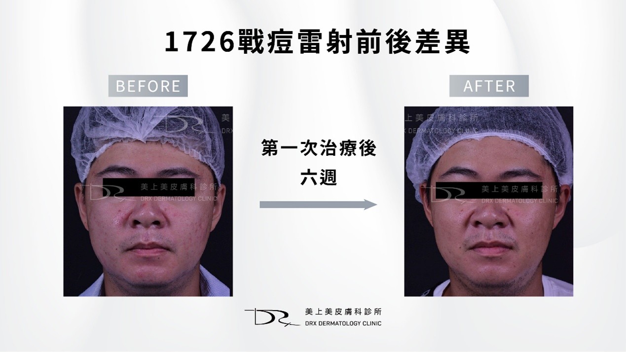 怎麼改善毛孔粗大？毛孔粗大保養品和毛孔粗大醫美方式！