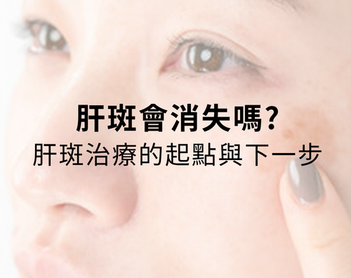 肝斑會消失嗎?肝斑治療的起點與下一步? 肝斑會消失嗎?肝斑治療的起點與下一步?