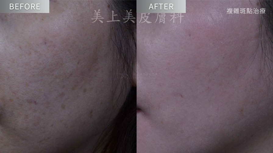 A醇有淡斑效果嗎？媽媽淡斑推薦保養步驟！