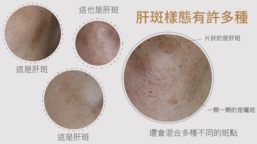 A醇有淡斑效果嗎？媽媽淡斑推薦保養步驟！