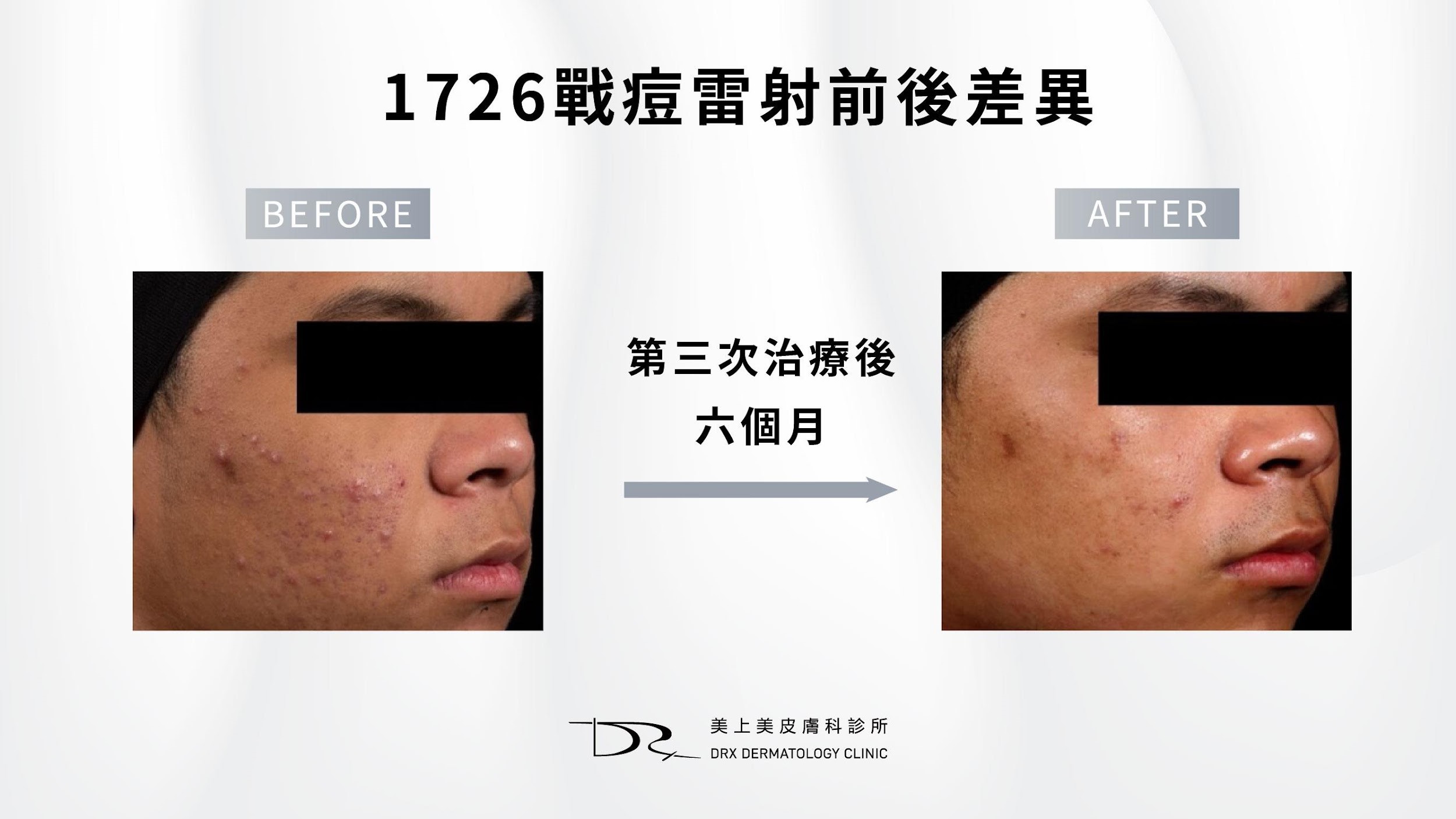 青春期如何讓皮膚變好？適合青春期的保養品！