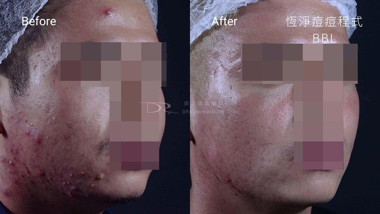 青春期如何讓皮膚變好？適合青春期的保養品！