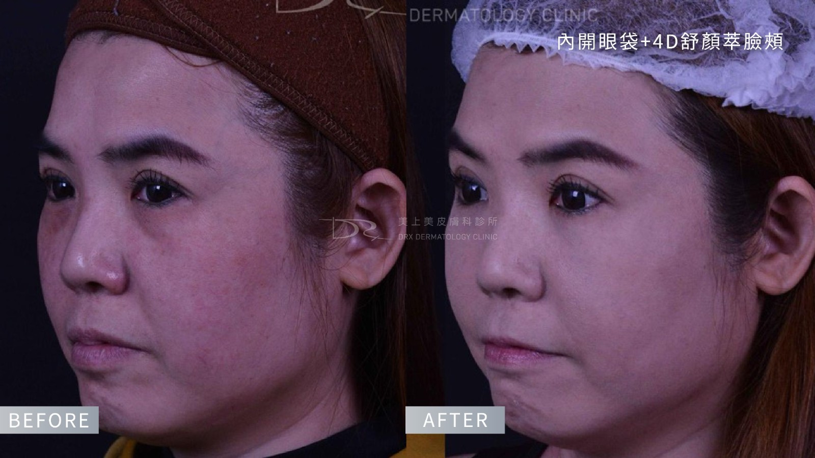 眼下遮瑕卡粉怎麼辦?黑眼圈要用什麼顏色遮? 眼下遮瑕卡粉怎麼辦?黑眼圈要用什麼顏色遮?