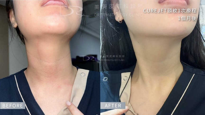 脖子美白？頸紋霜有用嗎？如何選擇適合的頸部保養成分？