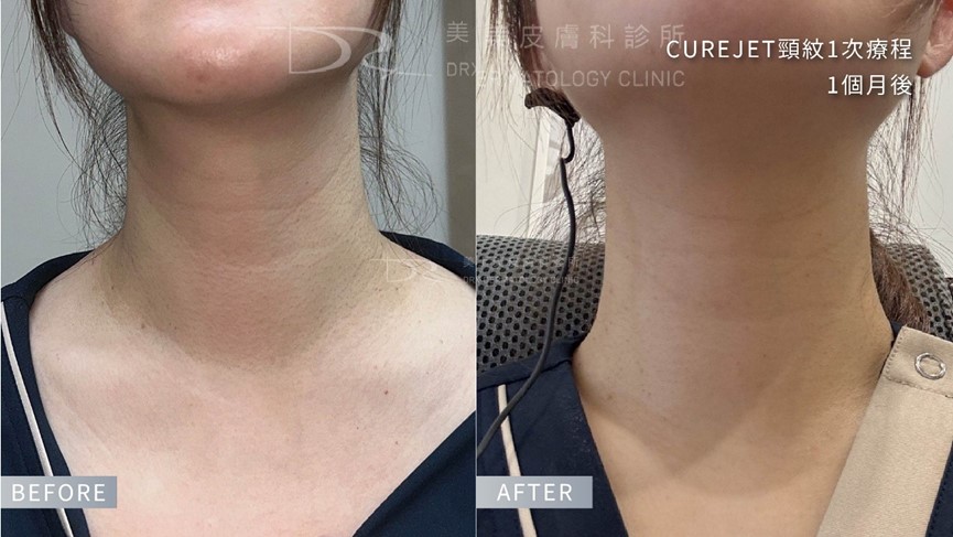 脖子美白？頸紋霜有用嗎？如何選擇適合的頸部保養成分？