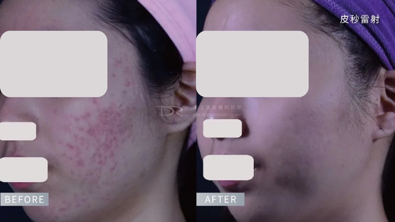 紅痘疤擦什麼保養品？痘痘泛紅怎麼辦？ 