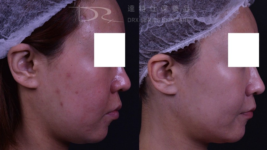 紅痘疤擦什麼保養品？痘痘泛紅怎麼辦？ 