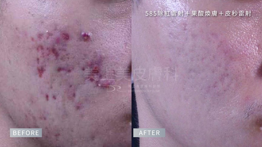 紅痘疤擦什麼保養品？痘痘泛紅怎麼辦？ 