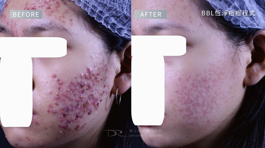 紅痘疤擦什麼保養品？痘痘泛紅怎麼辦？ 