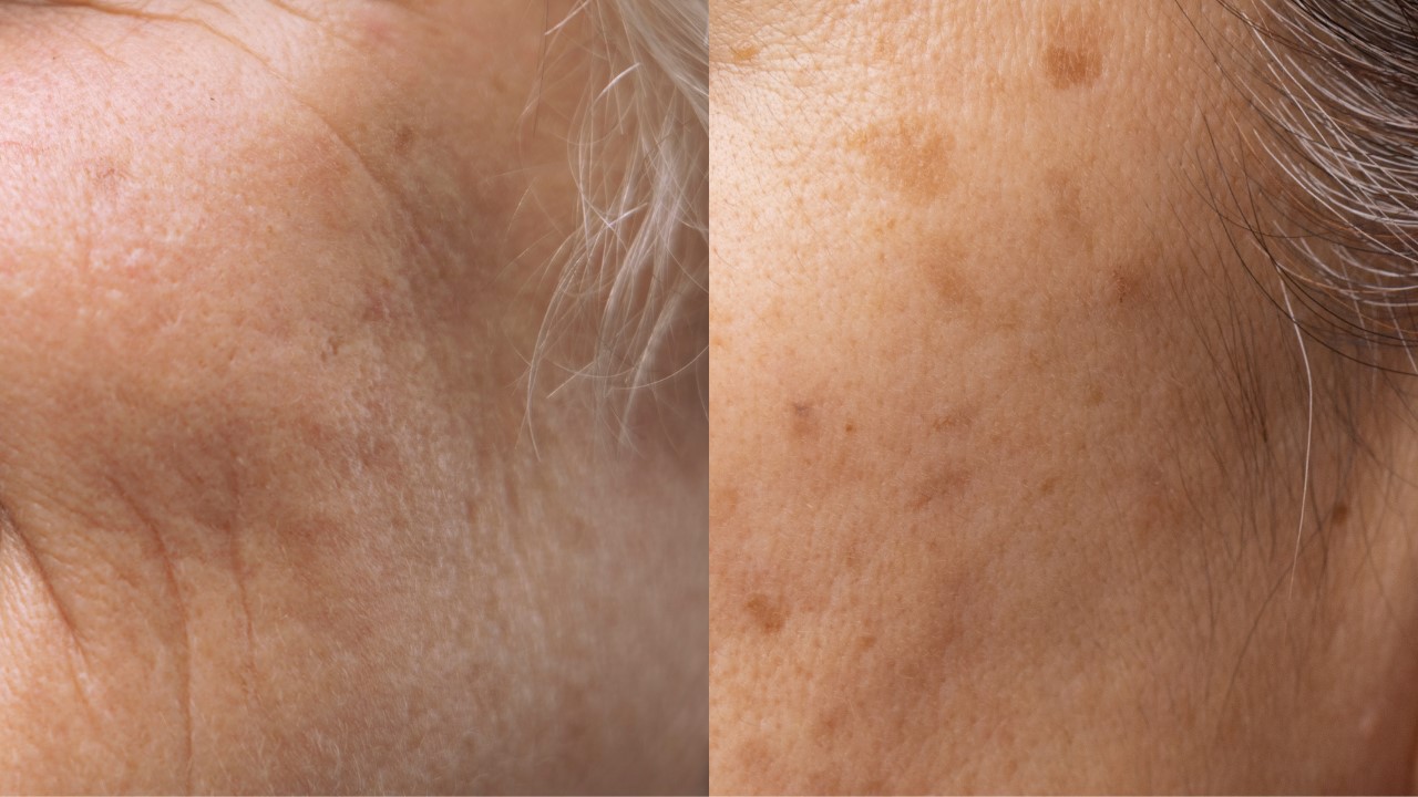 想靠吃一些天然食物來促進膠原蛋白增生嗎？今天就讓我們從「糖」的角度來談談哪些食物吃了可以幫助增加膠原蛋白、哪些則有反效果，因為有種東西叫「AGEs」（糖化終產物），會對我們皮膚有所影響，繼續看下去就知道囉！