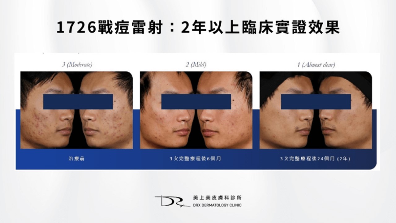 男生多久去一次角質？男生皮膚怎麼變好？男生護膚步驟秘訣？