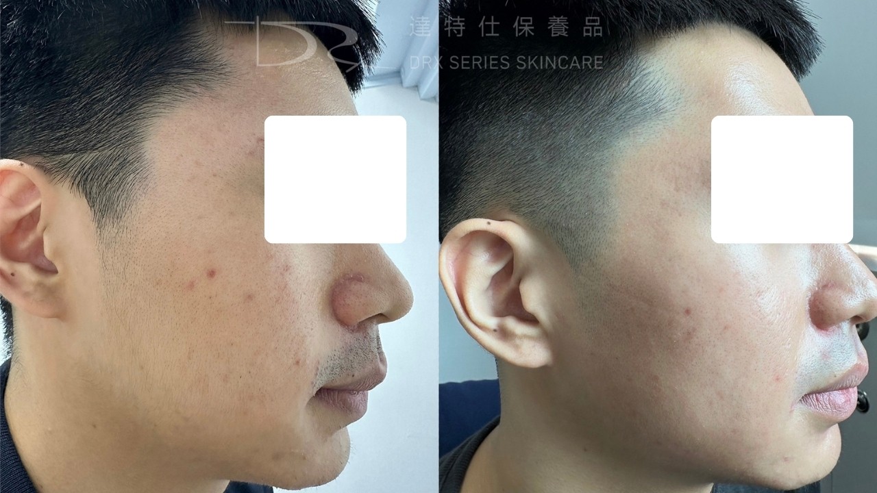 A 醇可以長期用嗎?毛孔粗大美白 A 醇用法,醫師教你「大 A、小 A」實用A醇擦法! A 醇可以長期用嗎?毛孔粗大美白 A 醇用法,醫師教你「大 A、小 A」實用A醇擦法!