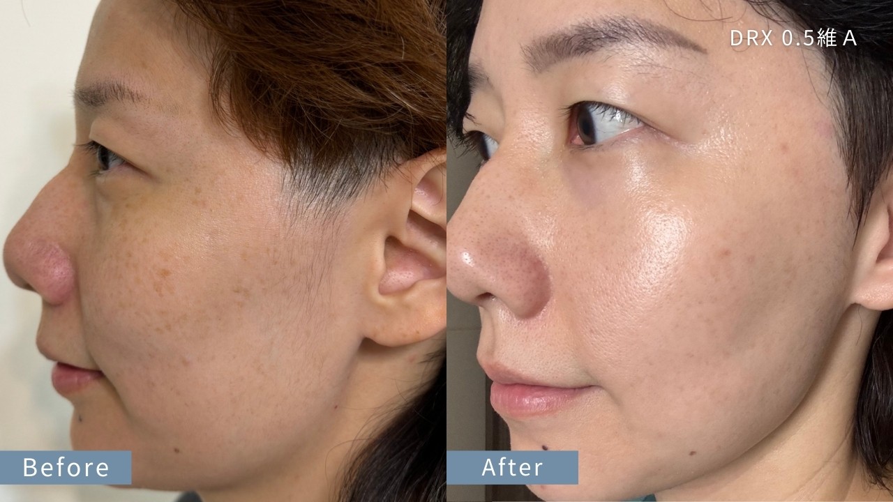 A 醇可以長期用嗎?毛孔粗大美白 A 醇用法,醫師教你「大 A、小 A」實用A醇擦法! A 醇可以長期用嗎?毛孔粗大美白 A 醇用法,醫師教你「大 A、小 A」實用A醇擦法!