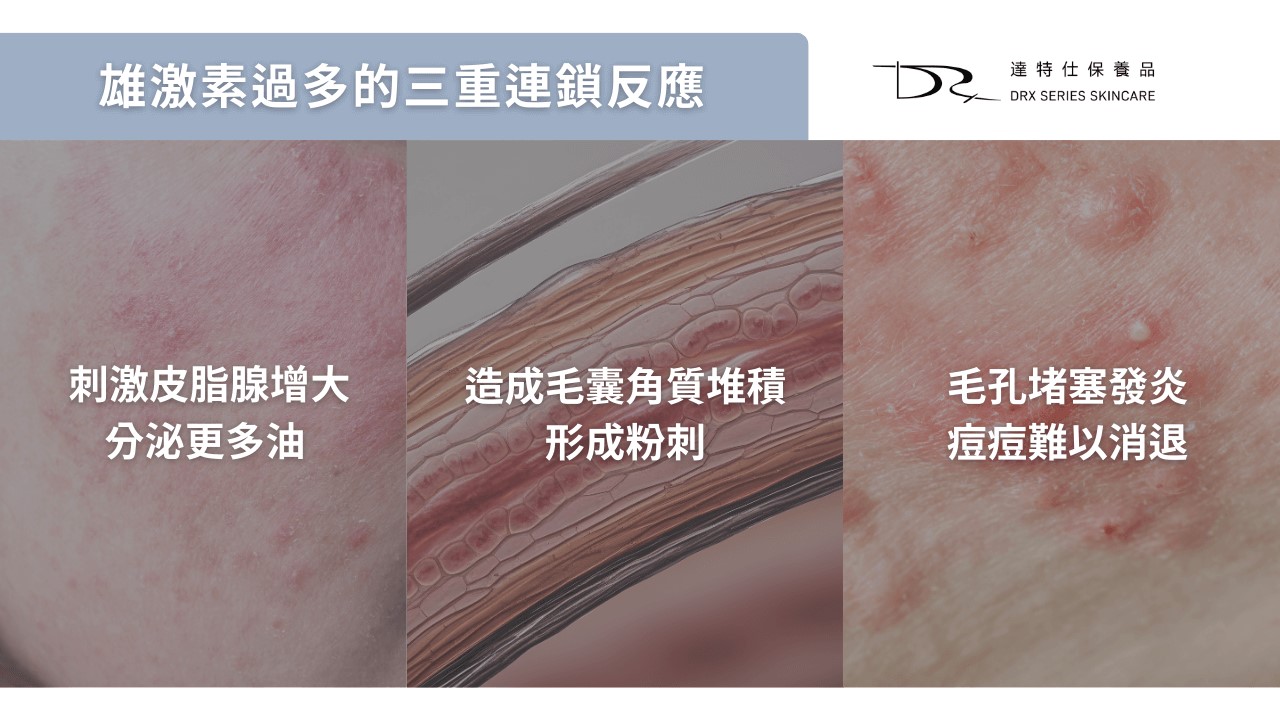 多囊痘痘怎麼辦？PCOS 痘痘原因與保養成分怎麼選