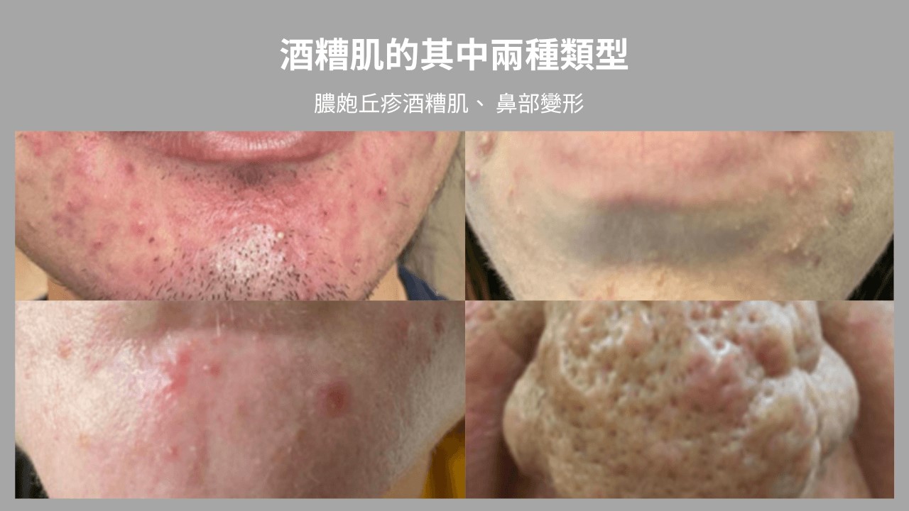 酒糟可以用B5嗎?酒糟A醛、酒糟水楊酸怎麼擦? 酒糟可以用B5嗎?酒糟A醛、酒糟水楊酸怎麼擦?