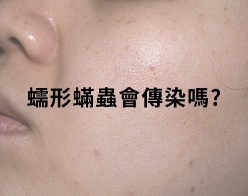 蠕形蟎蟲會傳染嗎? 蠕形蟎蟲會傳染嗎?