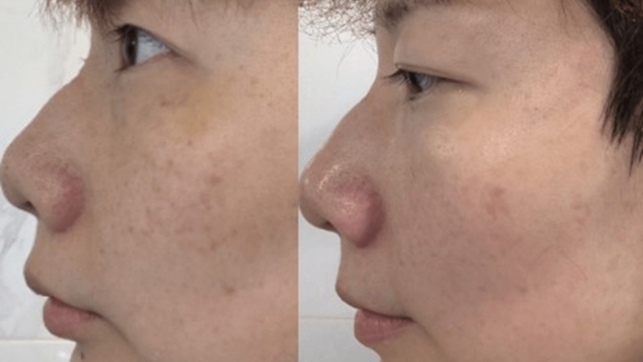 神經醯胺可以淡斑嗎？神經醯胺口服有效嗎？