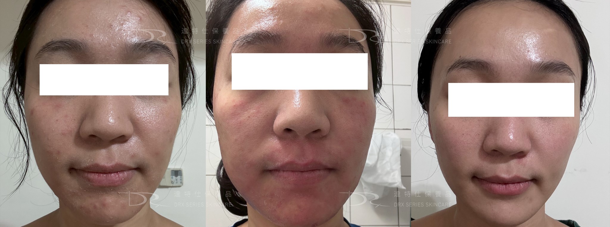 菸鹼醯胺、杏仁酸能一起用？