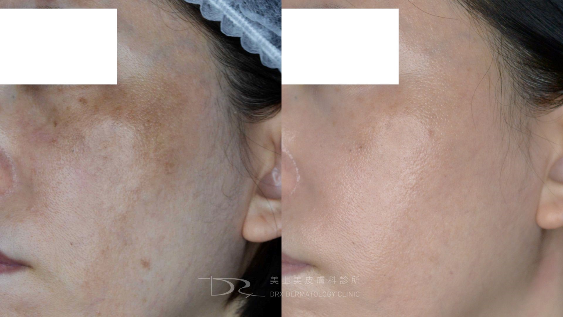 空氣不好會長痘痘嗎?室內空污會漲黑斑、讓皺紋會變多? 空氣不好會長痘痘嗎?室內空污會漲黑斑、讓皺紋會變多?