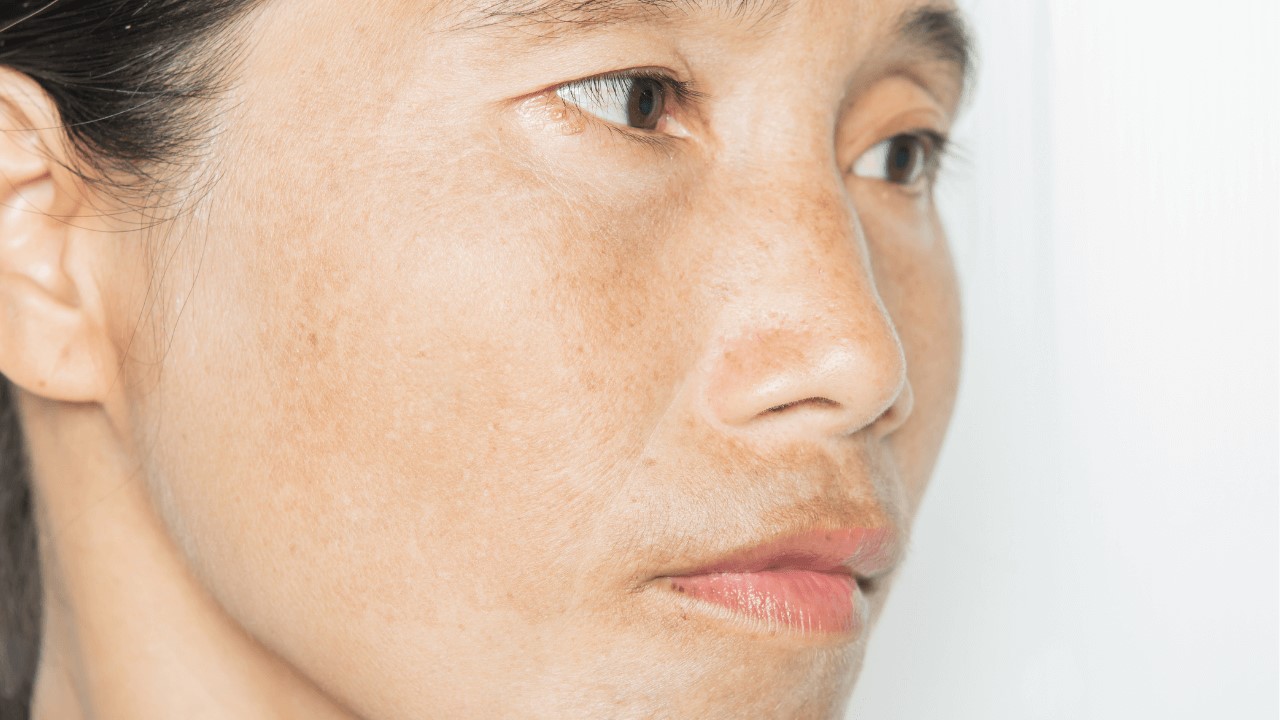 空氣不好會長痘痘嗎?室內空污會漲黑斑、讓皺紋會變多? 空氣不好會長痘痘嗎?室內空污會漲黑斑、讓皺紋會變多?