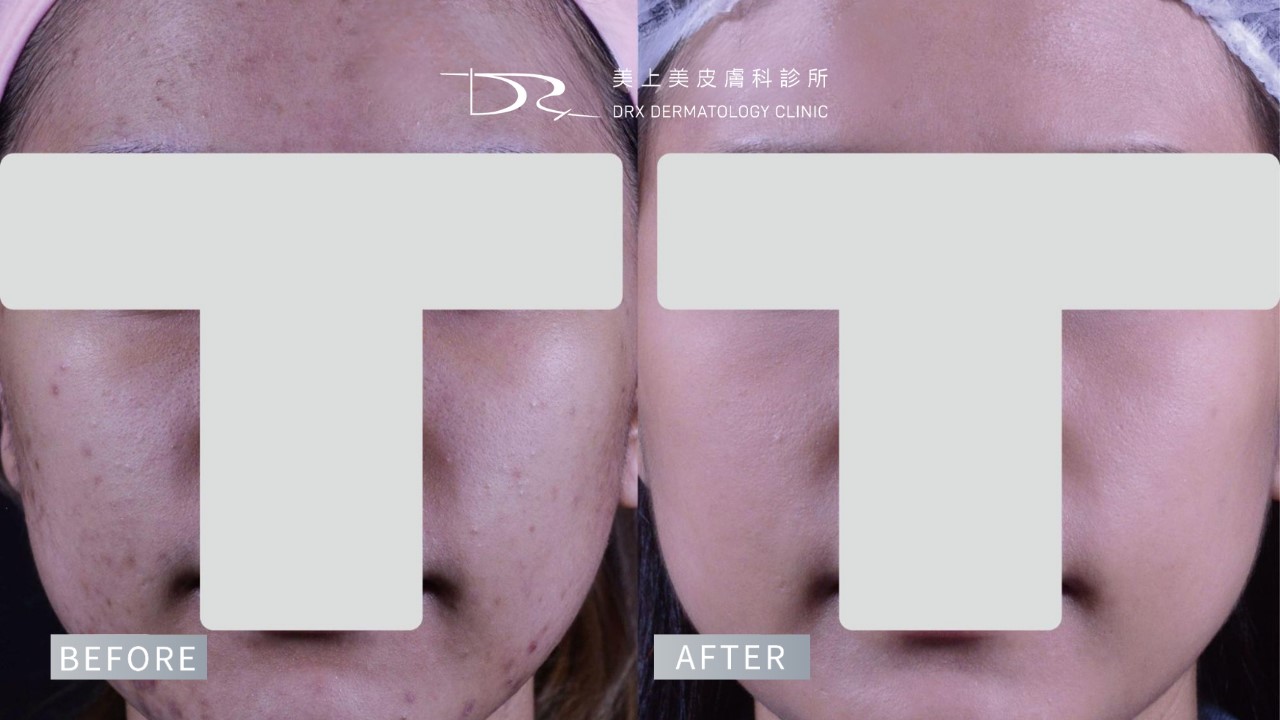 2026水光肌保養早晚步驟!熱門水光肌保養品成分、水光肌醫美療程一次看! 2026水光肌保養早晚步驟!熱門水光肌保養品成分、水光肌醫美療程一次看!