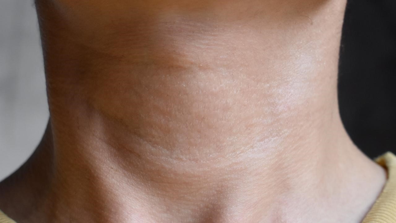 如何消除脖子紋？