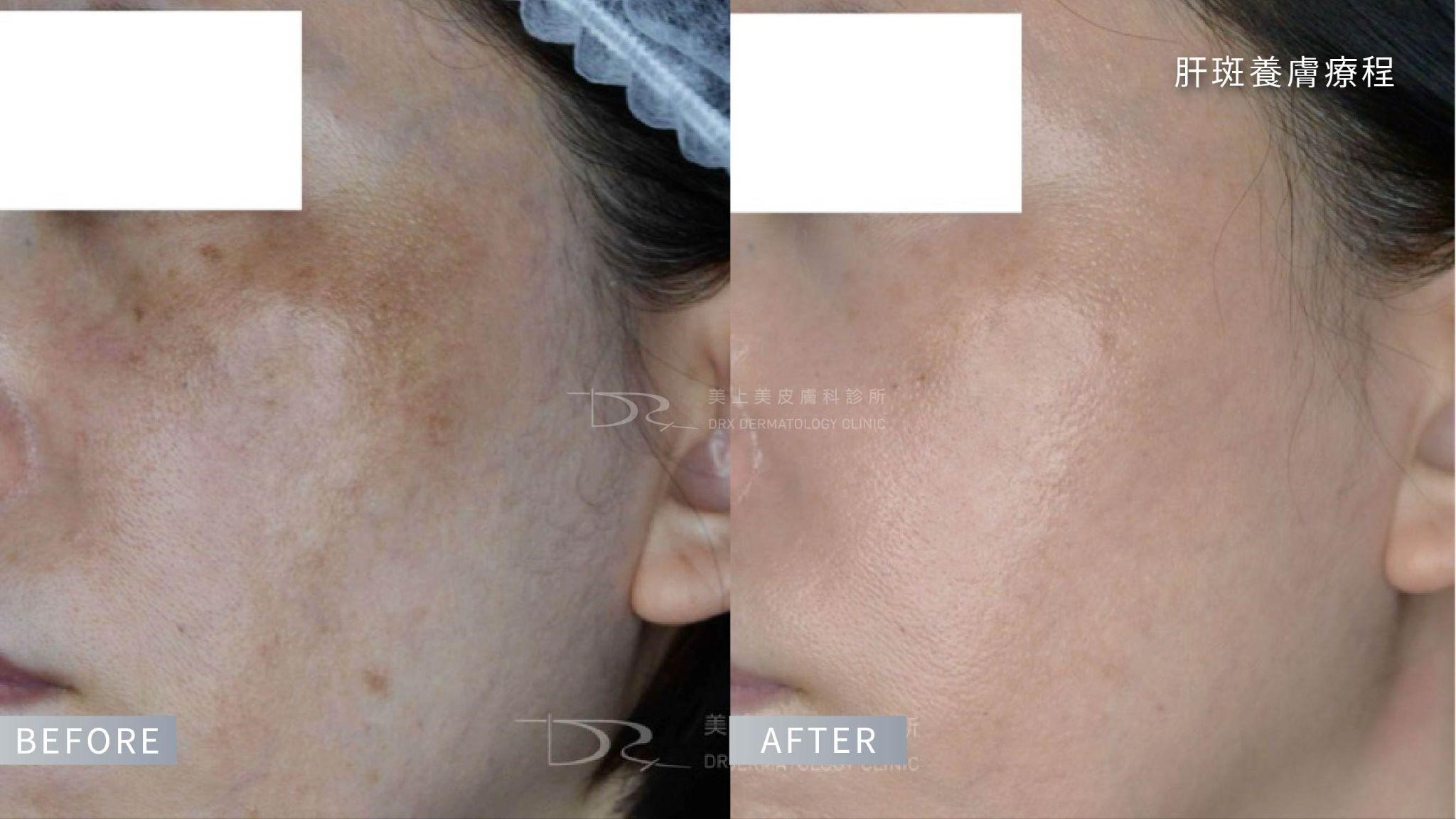 想淡斑看這裡！黑斑保養品、你不知道的11個錯誤淡斑知識一次看！