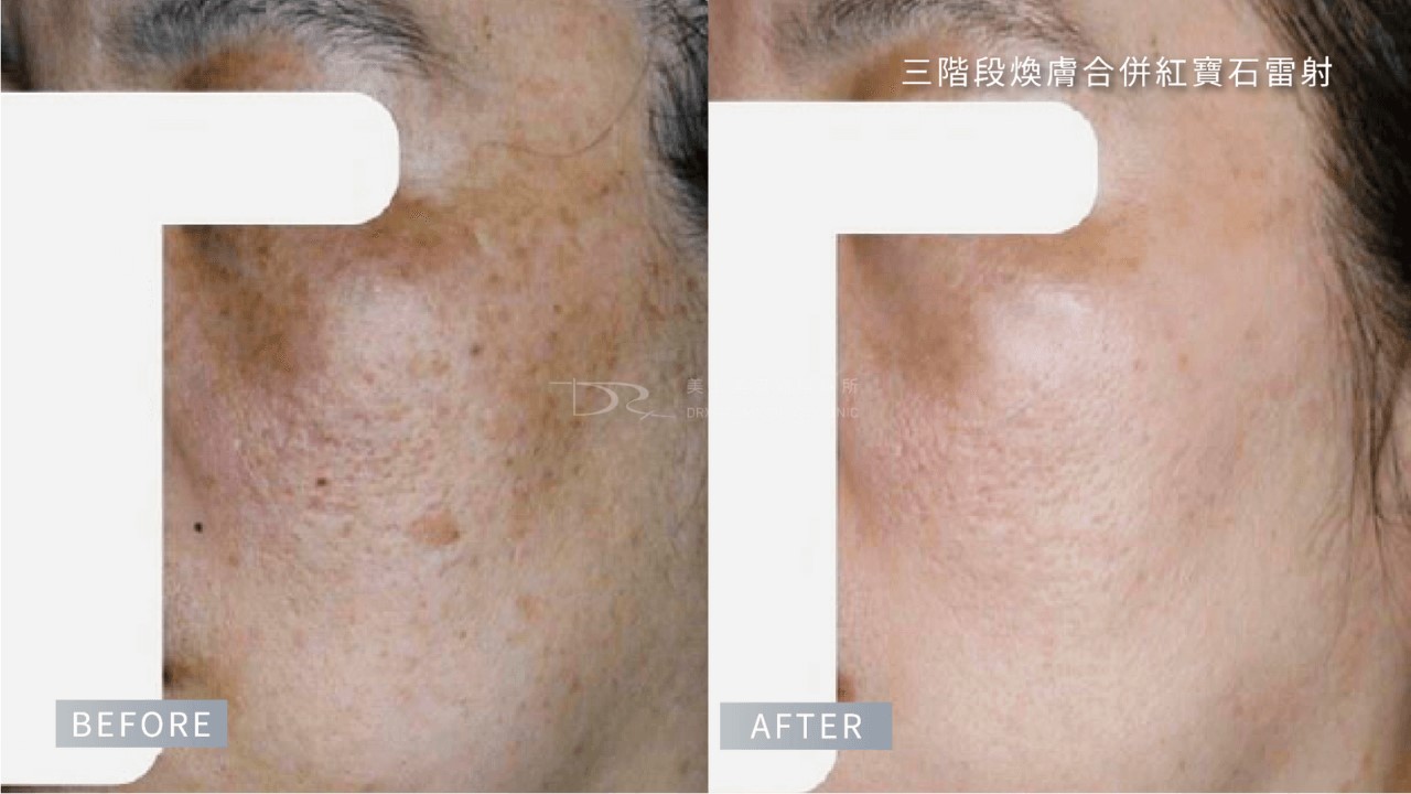 想淡斑看這裡！黑斑保養品、你不知道的11個錯誤淡斑知識一次看！