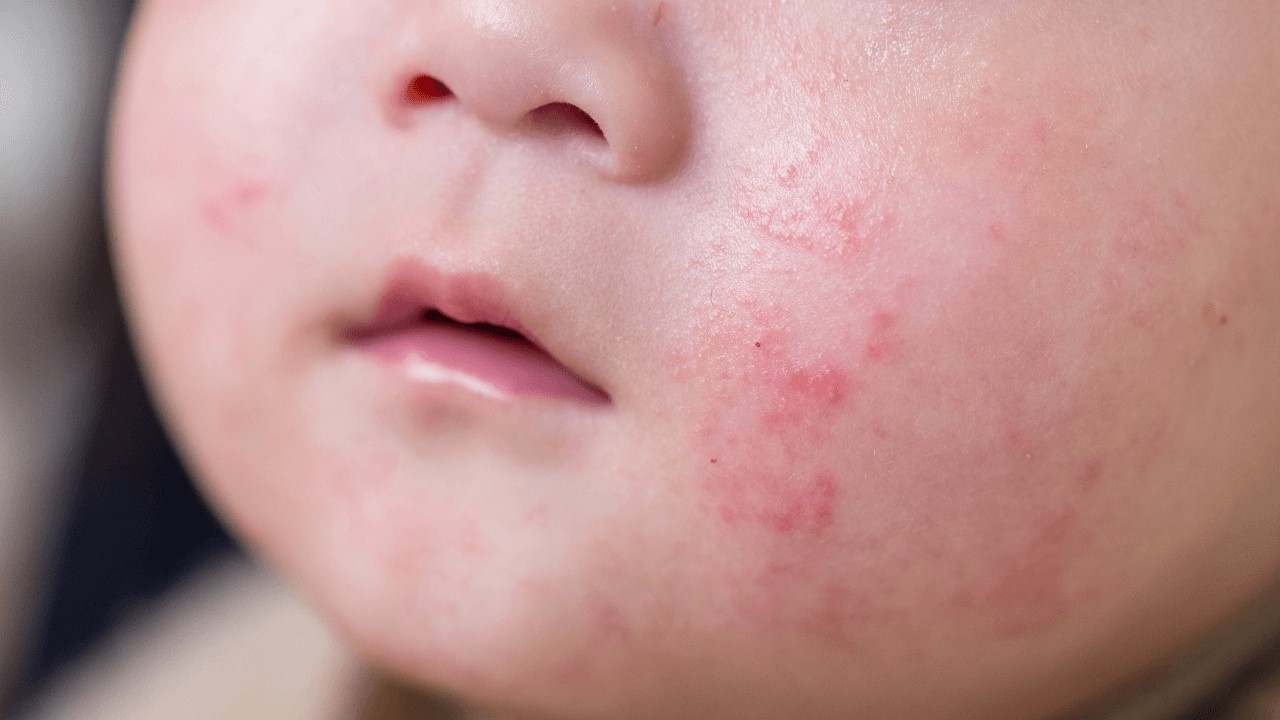 吃益生菌會讓皮膚變好嗎？吃益生菌對痘痘有幫助嗎？