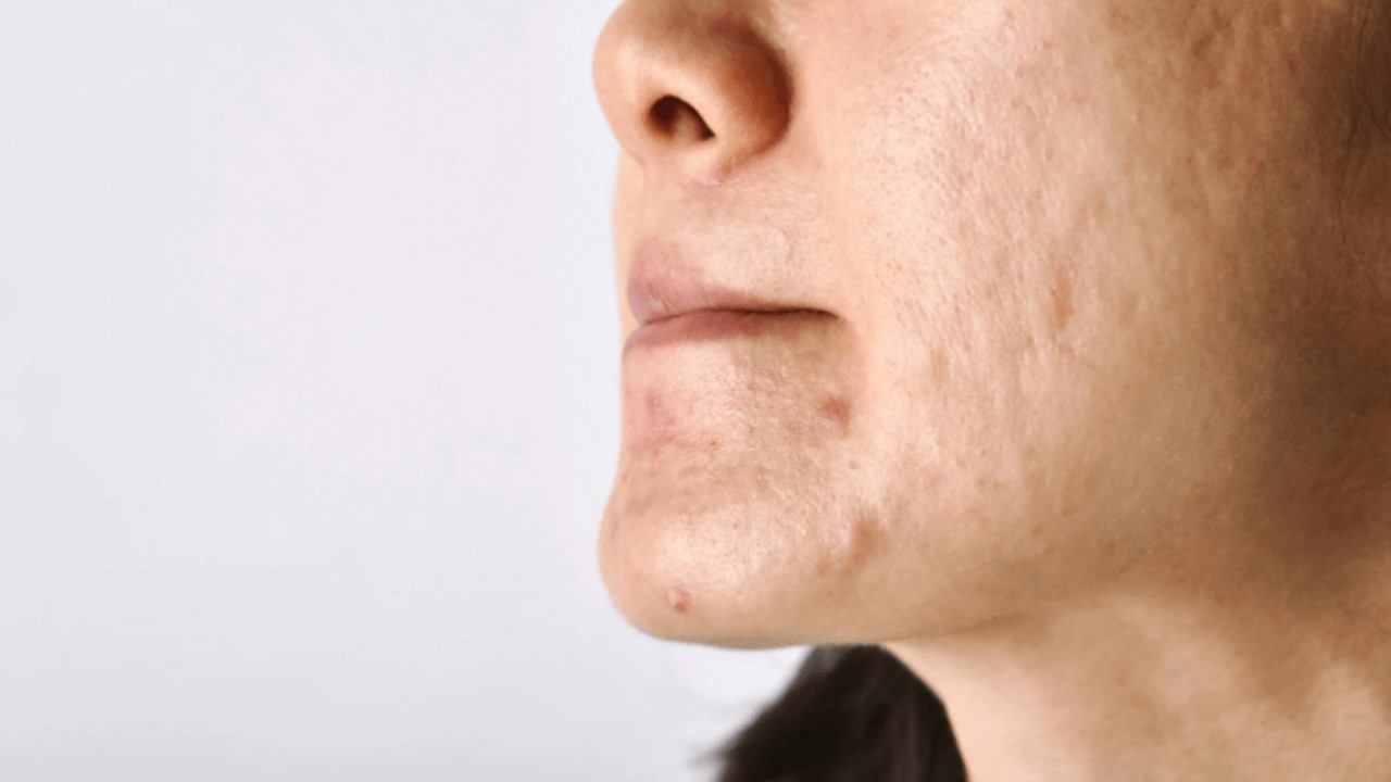 鋅可以改善痘痘嗎?鋅可以修復傷口嗎?掉髮吃鋅嗎? 鋅可以改善痘痘嗎?鋅可以修復傷口嗎?掉髮吃鋅嗎?