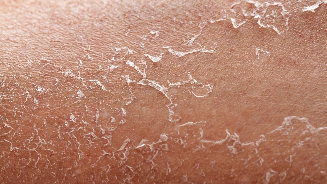 擦A酸脫皮還要擦嗎? 擦A酸脫皮還要擦嗎?