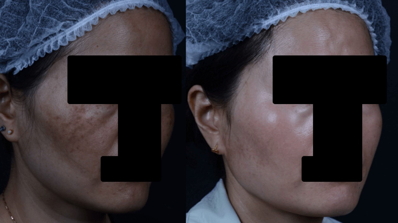 肝斑如何變淡？肝斑要擦什麼保養品？