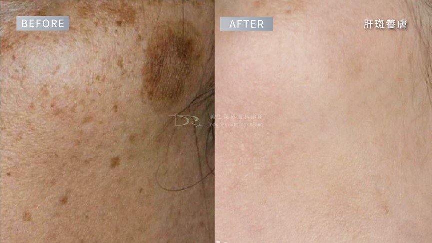 肝斑如何變淡？肝斑要擦什麼保養品？